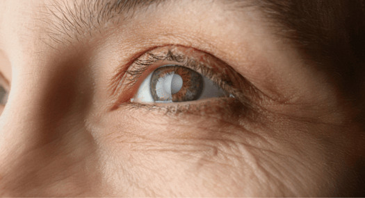 ¿Cuándo operarse de miopía? Guía sobre la cirugía ocular