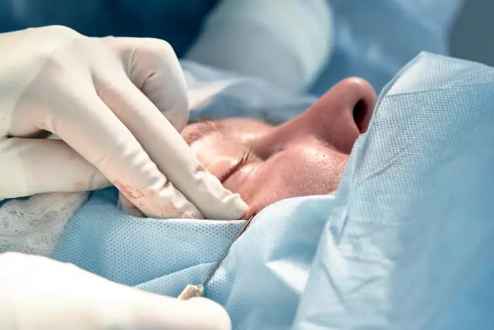 close-up-of-the-face-of-patient-who-is-undergoing-blepharoplasty-the-surgeon-cuts-the-eyelid-and-performs-manipulations-using-medical-instruments-min (1)