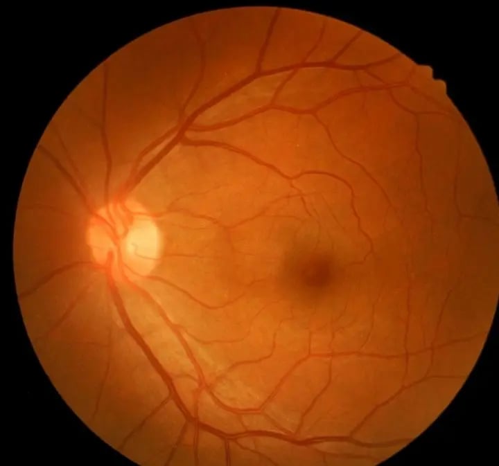 retina-2