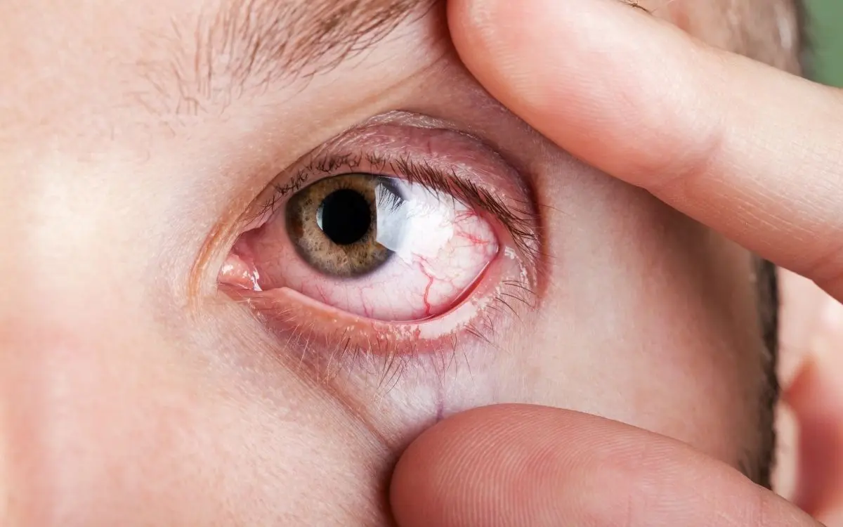 Dry eye syndrome: your eyes need all the tears