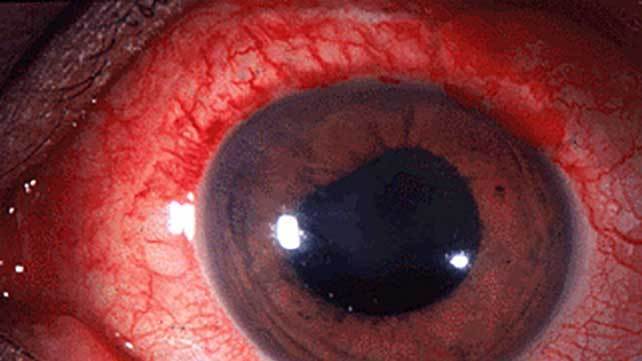 La uveítis, una enfermedad ocular que se puede prevenir